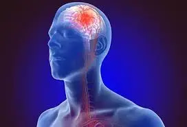 Brain Stroke Brain Stroke