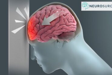 Head-Injury-Dr-Amit-Deora-Best-Neurologist-in-Indore Head-Injury-Dr-Amit-Deora-Best-Neurologist-in-Indore