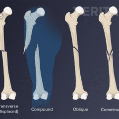 Fast Emergency Response for a Fracture