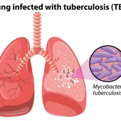 Beating Tuberculosis with Expert Care