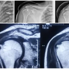 Shoulder Biceps Tendon Disease & Bankart Repair Surgery | Balanku Hospital