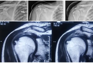 Get advanced arthroscopic treatment for shoulder biceps tendon disease and Bankart lesions at Balanku Hospital. Expert care for stable, pain-free shoulder movement. Get advanced arthroscopic treatment for shoulder biceps tendon disease and Bankart lesions at Balanku Hospital. Expert care for stable, pain-free shoulder movement.