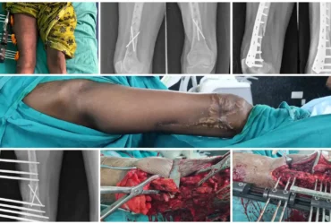 Infected Non-Union Femur Surgery & Limb Reconstruction Balanku Hospital Infected Non-Union Femur Surgery & Limb Reconstruction Balanku Hospital