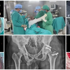 Pipkin Fracture (Femoral Head Fracture) Treatment | Balanku Hospital