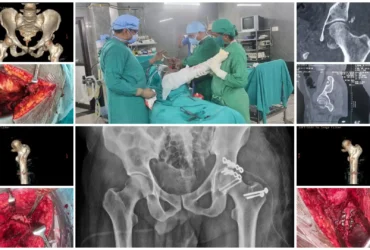 Pipkin Fracture (Femoral Head Fracture) Treatment Balanku Hospital Pipkin Fracture (Femoral Head Fracture) Treatment Balanku Hospital