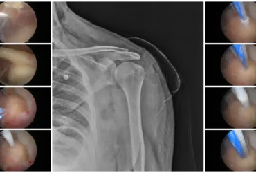 Rotator Cuff Tear Surgery & Treatment Balanku Hospital Raichur Rotator Cuff Tear Surgery & Treatment Balanku Hospital Raichur