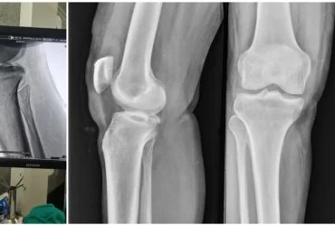 Right PCL Avulsion Fracture Treated with PCL Avulsion Fixation Balanku Hospital