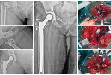 Successful Recovery from a Complex Right Intertrochanteric Fracture Complex Right Intertrochanteric Fracture Treatment