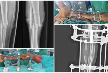 Compound Right Tibia Fracture Type 3B Surgery Ilizarov & Bone Grafting Balanku Hospital
