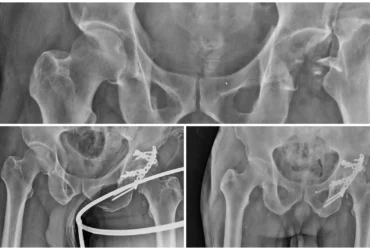 Left Acetabulum Fracture Dislocation Surgery ORIF Balanku Hospital