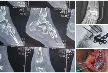 Left Calcaneum Fracture Surgery with Plates & Screws Balanku Hospital