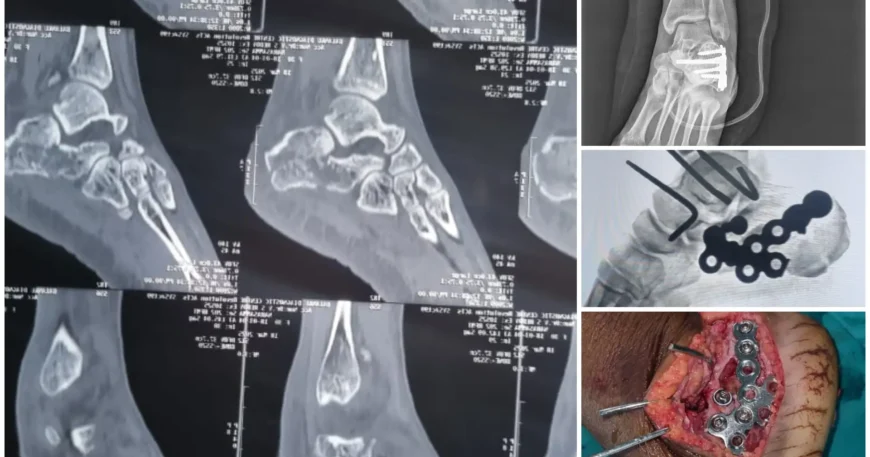 Left Calcaneum Fracture Surgery with Plates & Screws Balanku Hospital