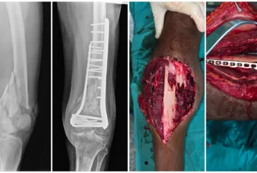 Left Distal Femur Fracture Surgery Dual Plate ORIF Balanku Hospital