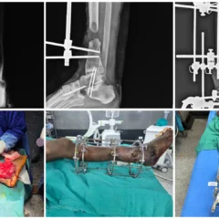 Masquelet Technique & Ilizarov for Distal Tibia Bone Defect | Balanku Hospital
