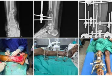 Masquelet Technique & Ilizarov for Distal Tibia Bone Defect Balanku Hospital