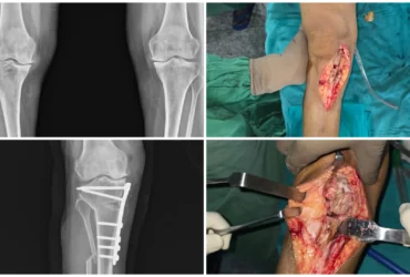 Medial Compartment Osteoarthritis of Right Knee Successfully Treated with High Tibial Osteotomy