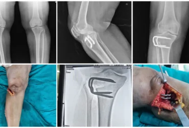 Medial Compartment Osteoarthritis of Right Knee Treated with High Tibial Osteotomy Balanku Hospital