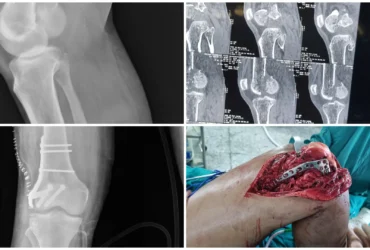 Right Distal Femur Fracture with Hoffa’s Surgery ORIF & CC Screw Balanku Hospital