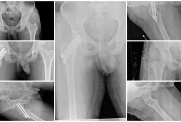 Right Femur Neck Fracture Surgery CRIF with CC Screws Balanku Hospital