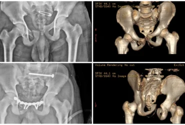 Right Pelvic Ring Fracture (Young–Burgess Vertical Shear) Treated with ORIF & SI Joint Fixation Balanku Hospital