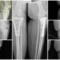 Right Proximal Tibia Fracture Surgery with Bicolumnar Plates | Balanku Hospital