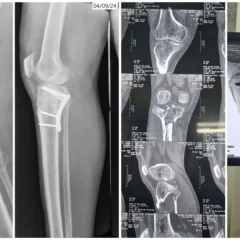 Right Proximal Tibia Fracture Surgery with Plates & Screws | Balanku Hospital
