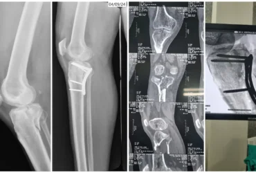 Right Proximal Tibia Fracture Surgery with Plates & Screws Balanku Hospital