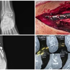 Right Trimalleolar Ankle Fracture Surgery | ORIF & TBW | Balanku Hospital