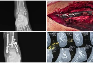 Right Trimalleolar Ankle Fracture Surgery ORIF & TBW Balanku Hospital