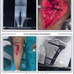 Save Your Natural Knee Joint – HTO Surgery