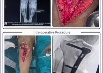 Save Your Natural Knee Joint – HTO Surgery Save Your Natural Knee Joint – HTO Surgery