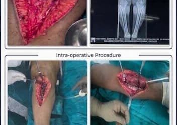 Save Your Natural Knee Joint – HTO Surgery Save Your Natural Knee Joint – HTO Surgery